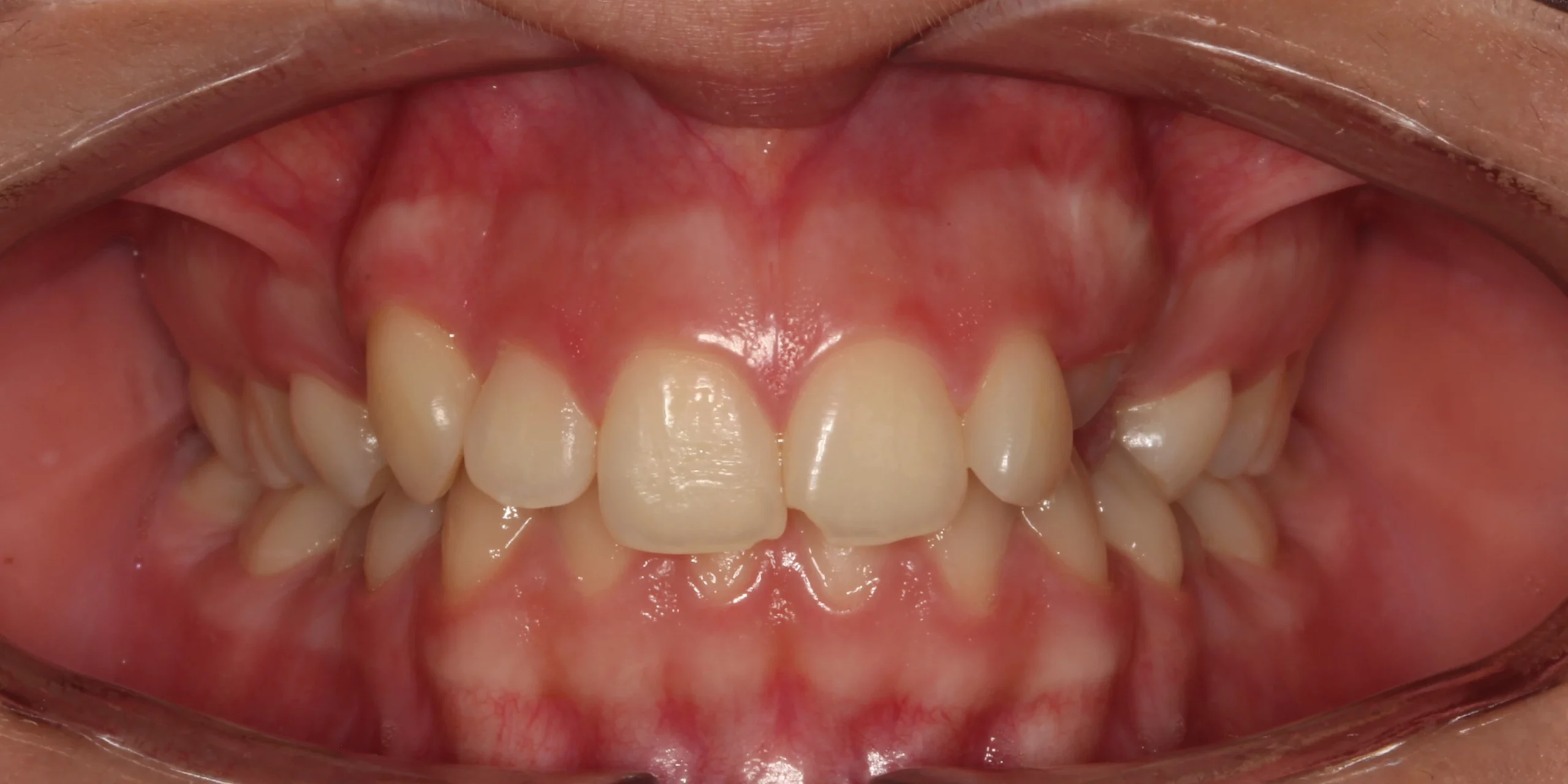 Intra-Oral-Frontal